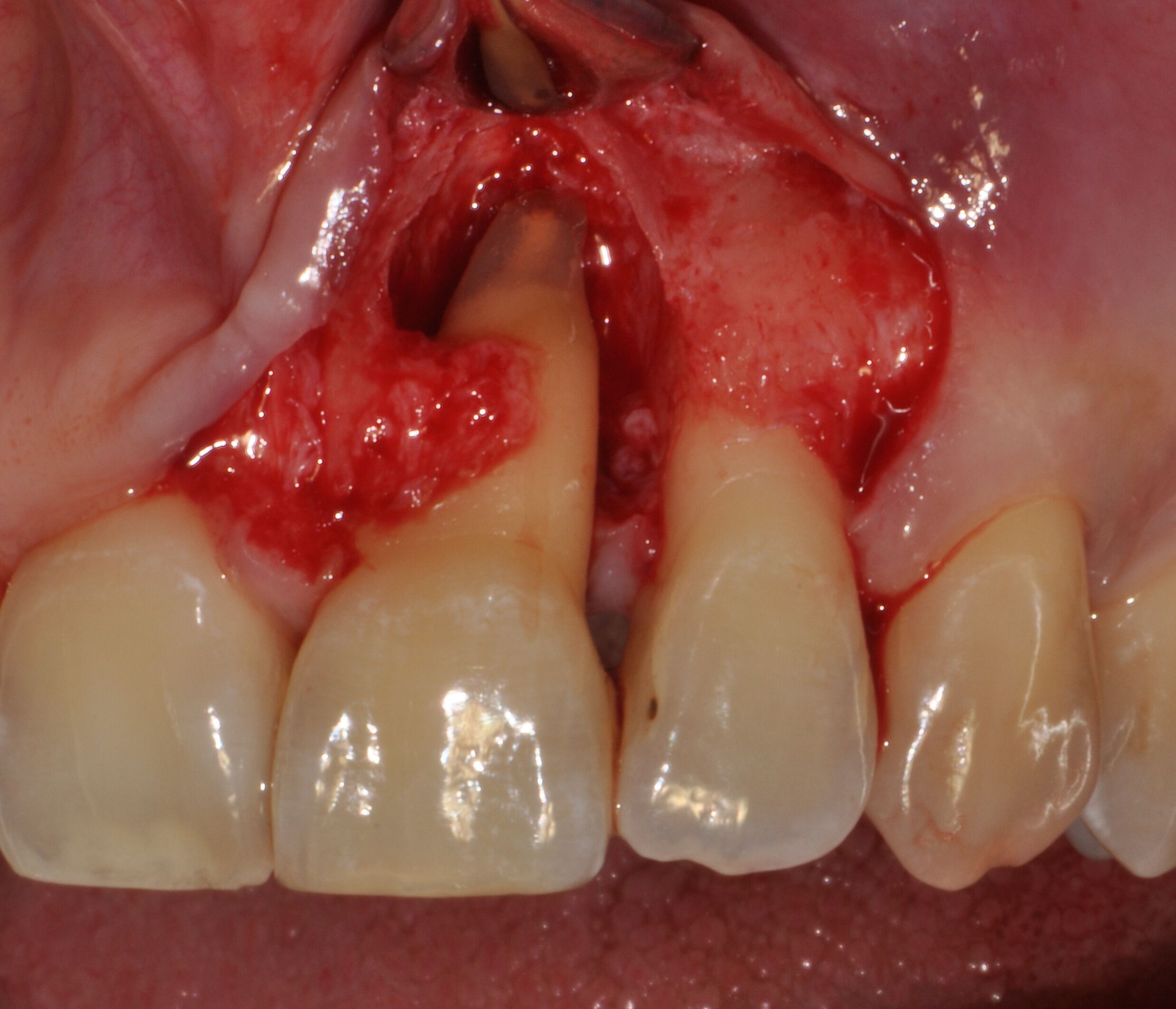 Intraoperative view of the surgical treatment of an upper left central incisor