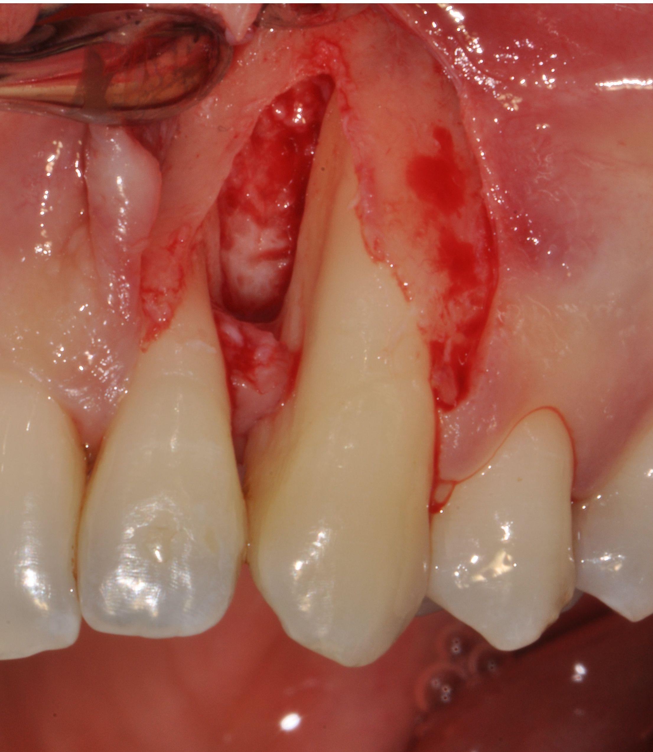 pre-treated periodontitis