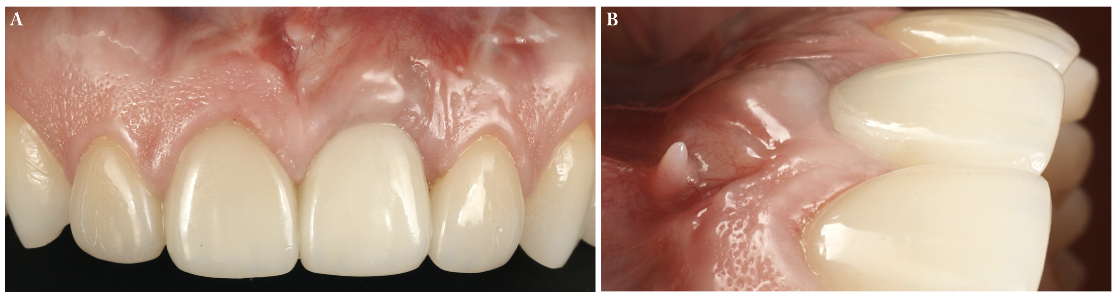 1-year outcome. It is possible to appreciate the complete coverage of the soft tissue dehiscence in the frontal view 