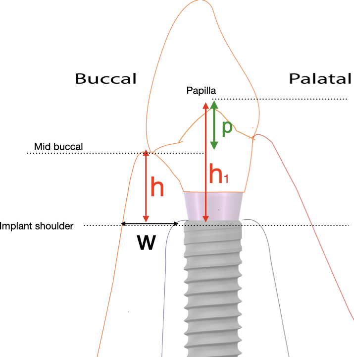 placement implant shoulder