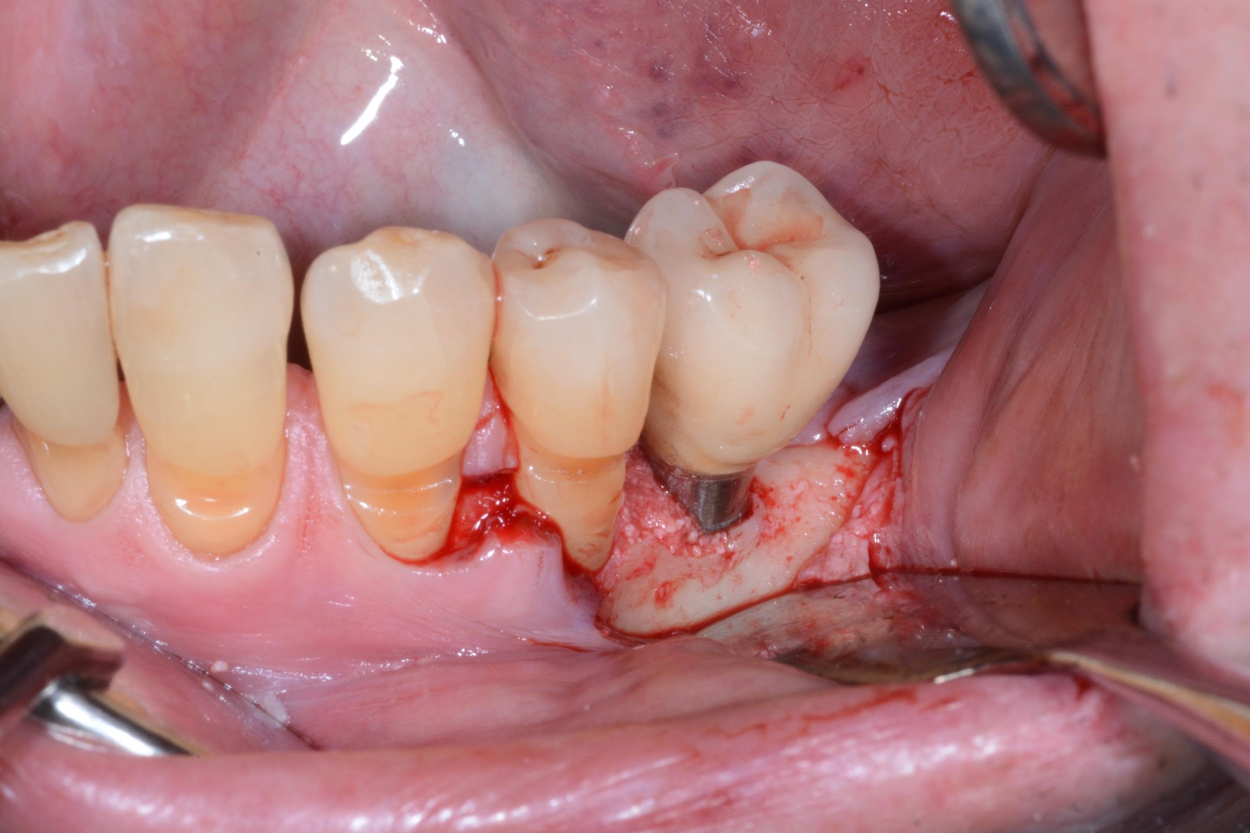 Clinical view of the peri-implant defect filled with a 