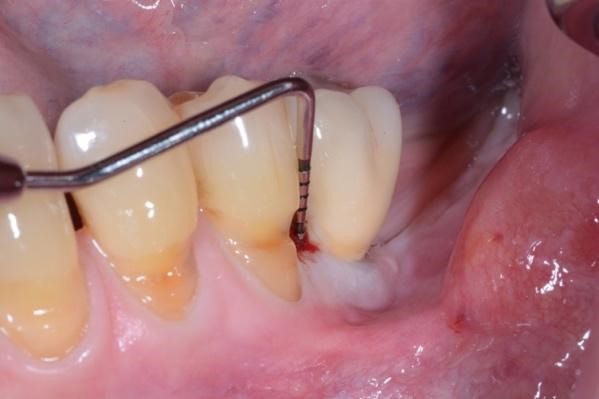 Clinical buccal view 