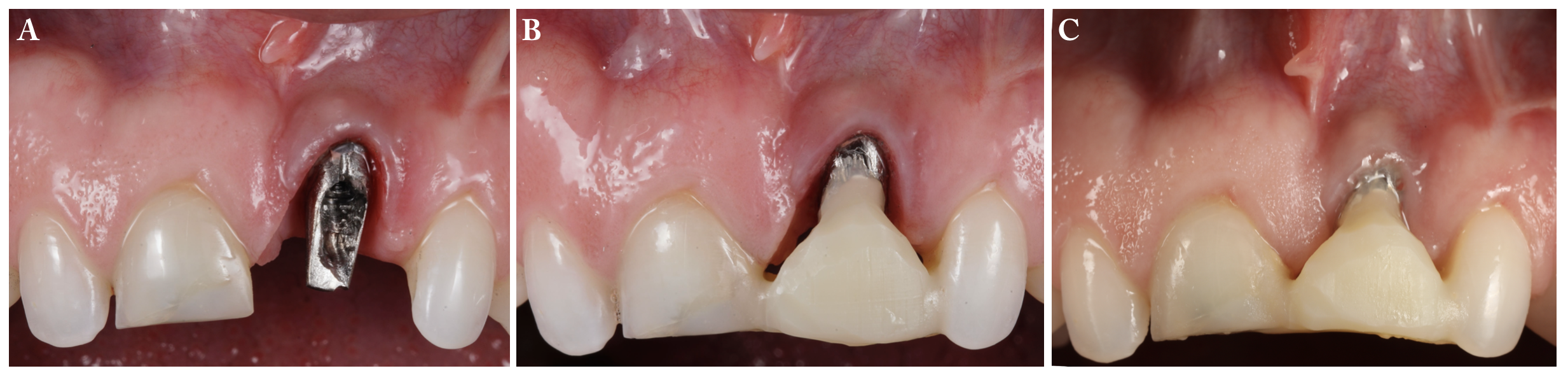 Frontal view of the PSTD after crown removal