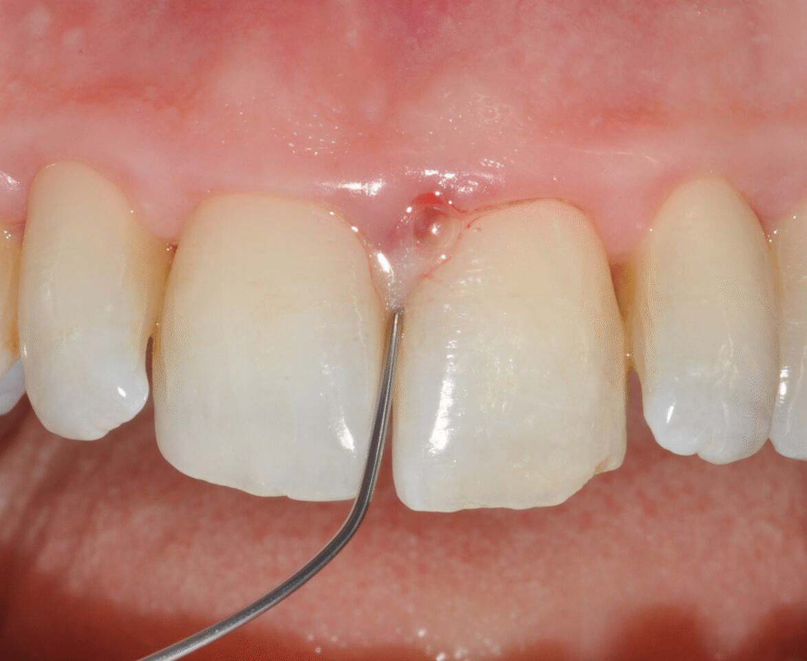 application of EDTA and Enamel Matrix Derivative gel in the mesial pocket of an upper right central incisor -1