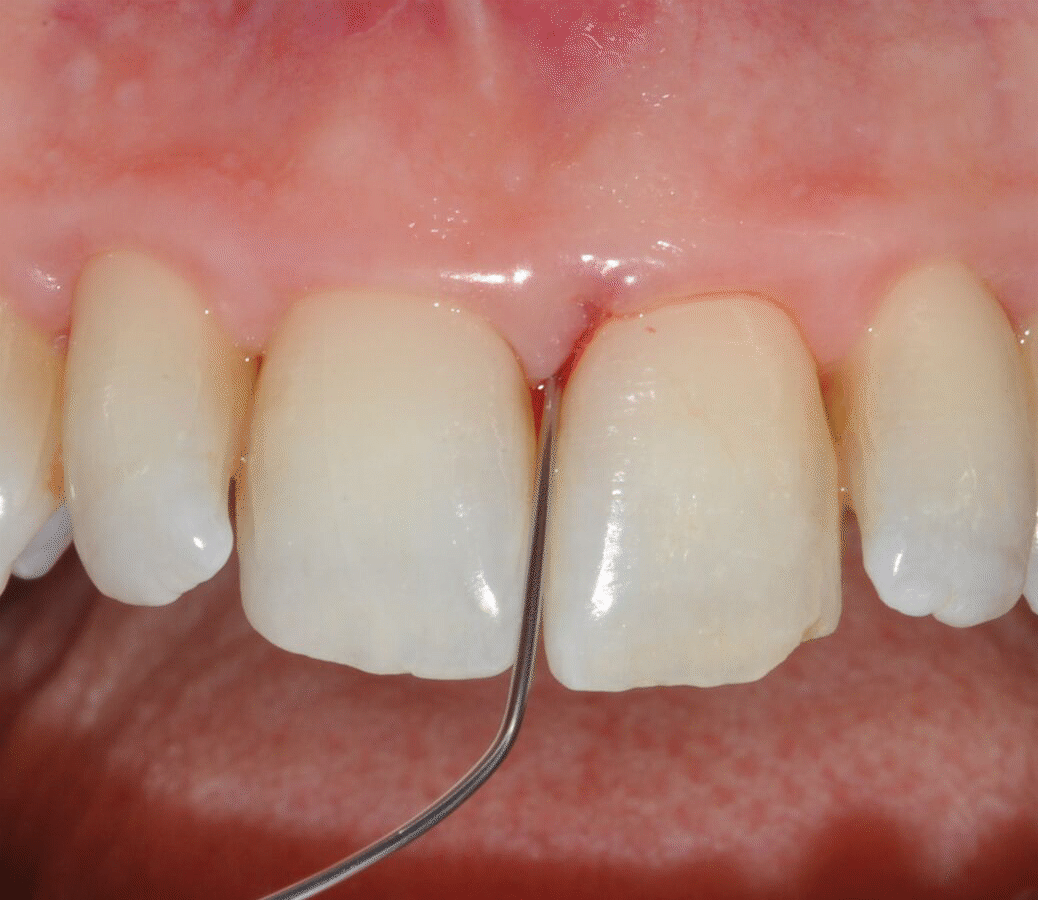 Application of EDTA and Enamel Matrix Derivative gel in the mesial pocket of an upper right central incisor   