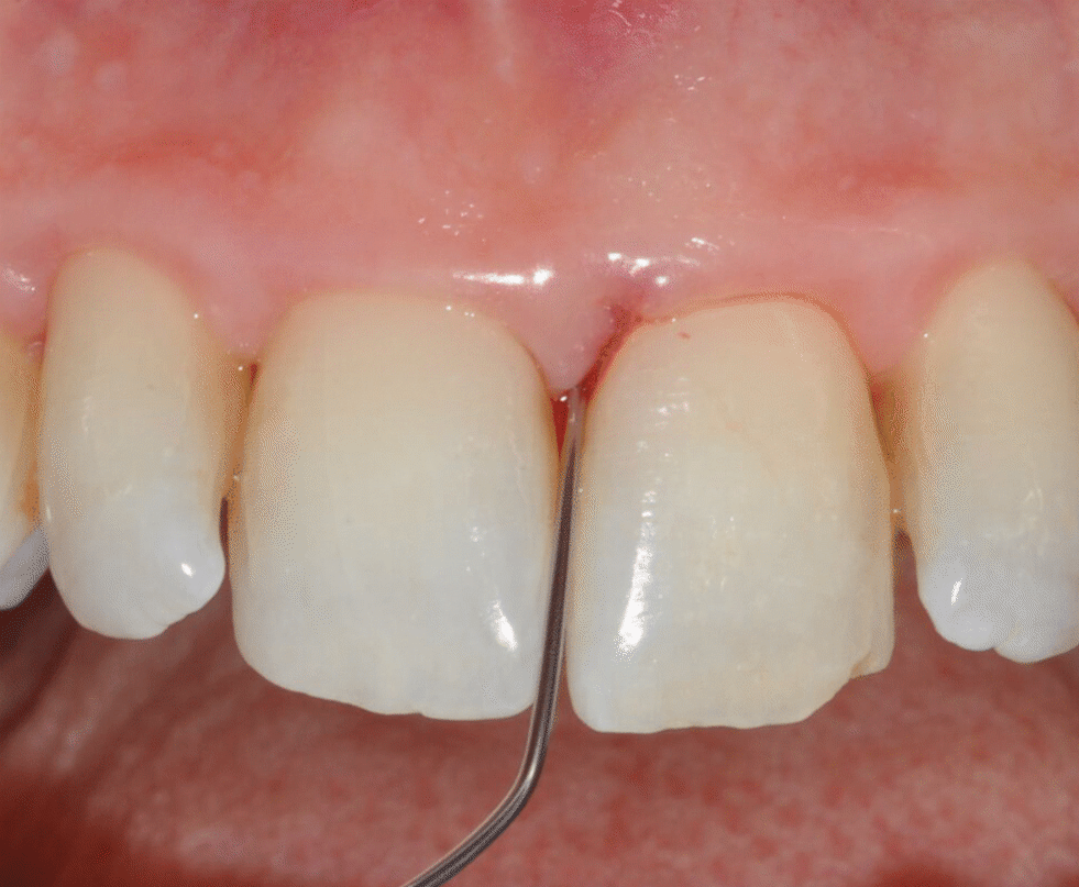  application of EDTA and Enamel Matrix Derivative gel in the mesial pocket of an upper right central incisor -2