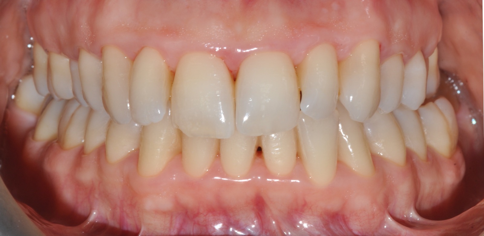 Periocampus Herald - Tomasi after treatment