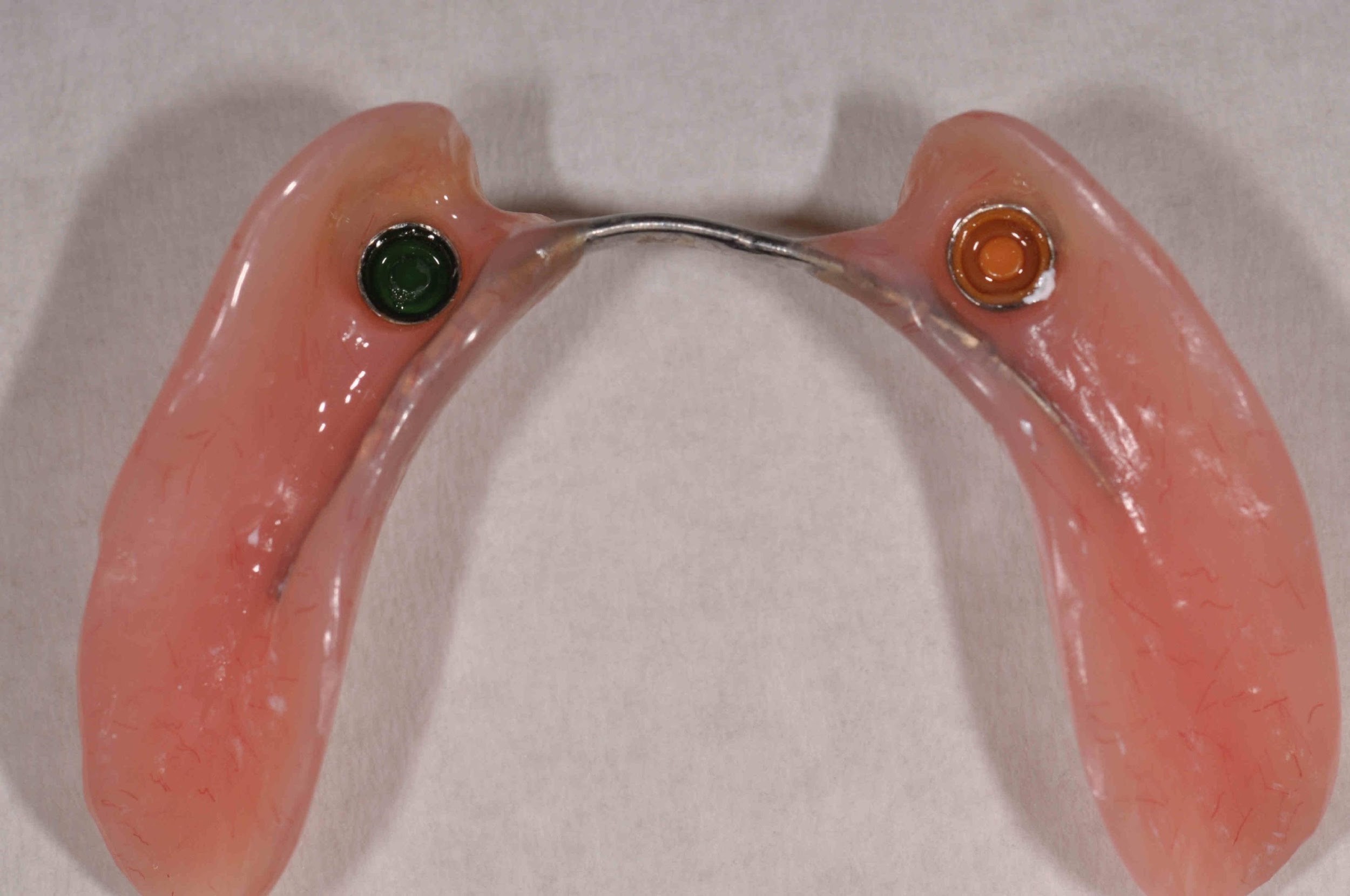 The simple design of the overdenture