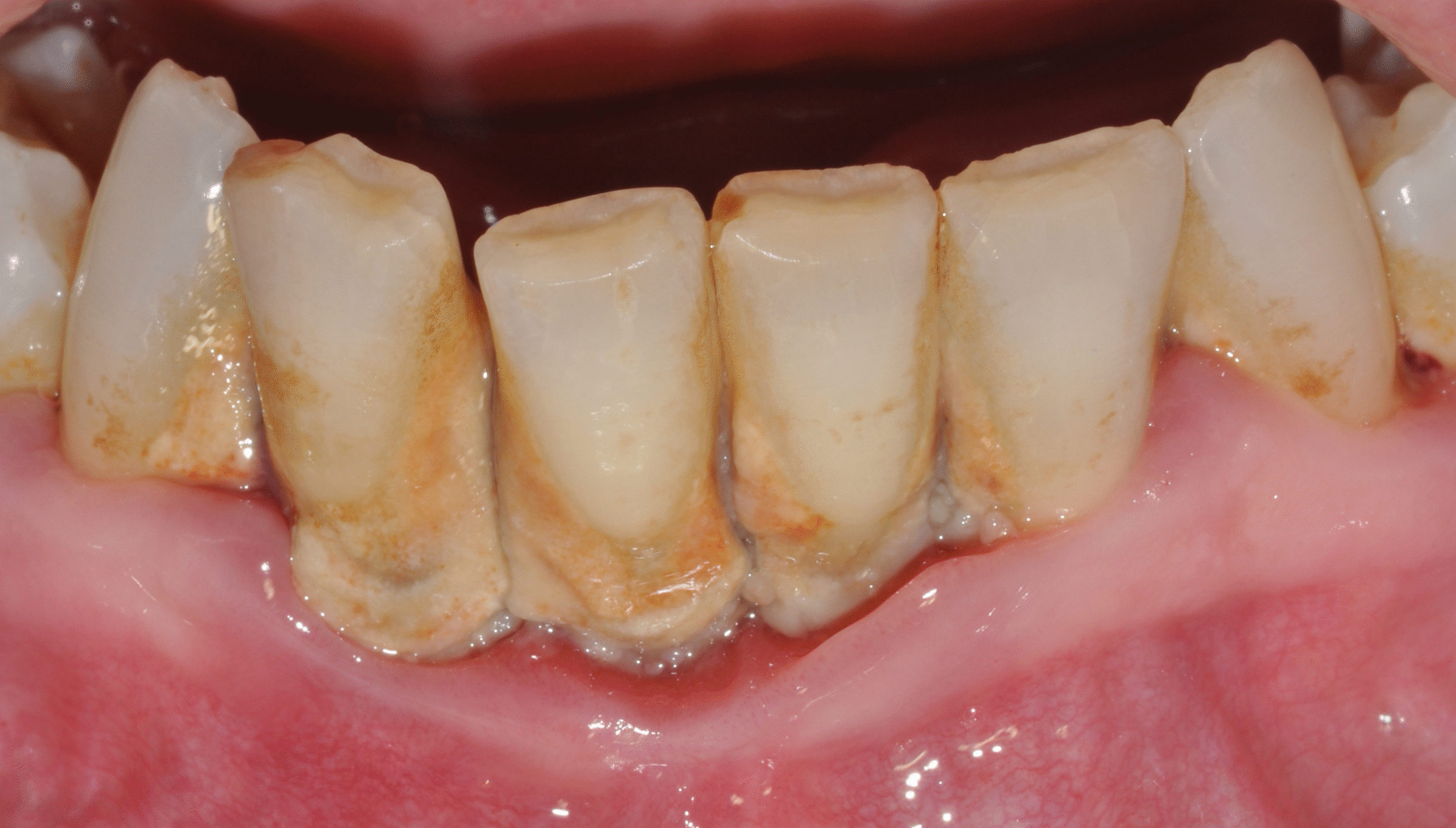 clinical pictures courtesy of Prof. Filippo Graziani