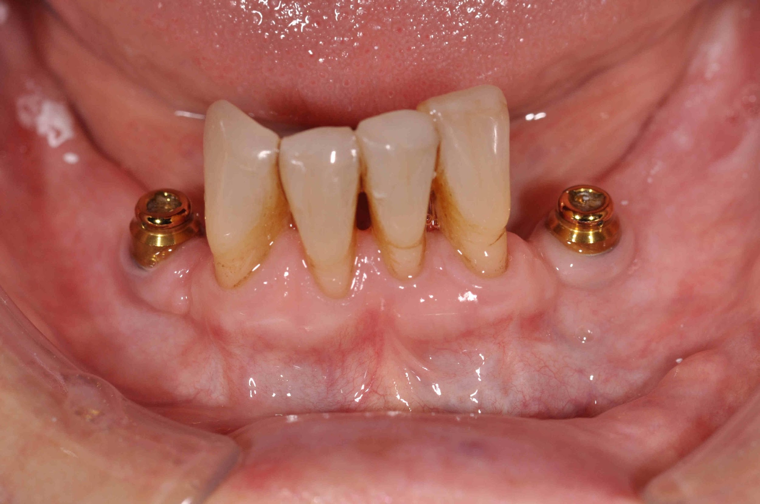 Healthy periodontal and peri-implant tissues, excellent oral hygiene and adequate space around the locator abutments for the locator housing and retaining acrylic