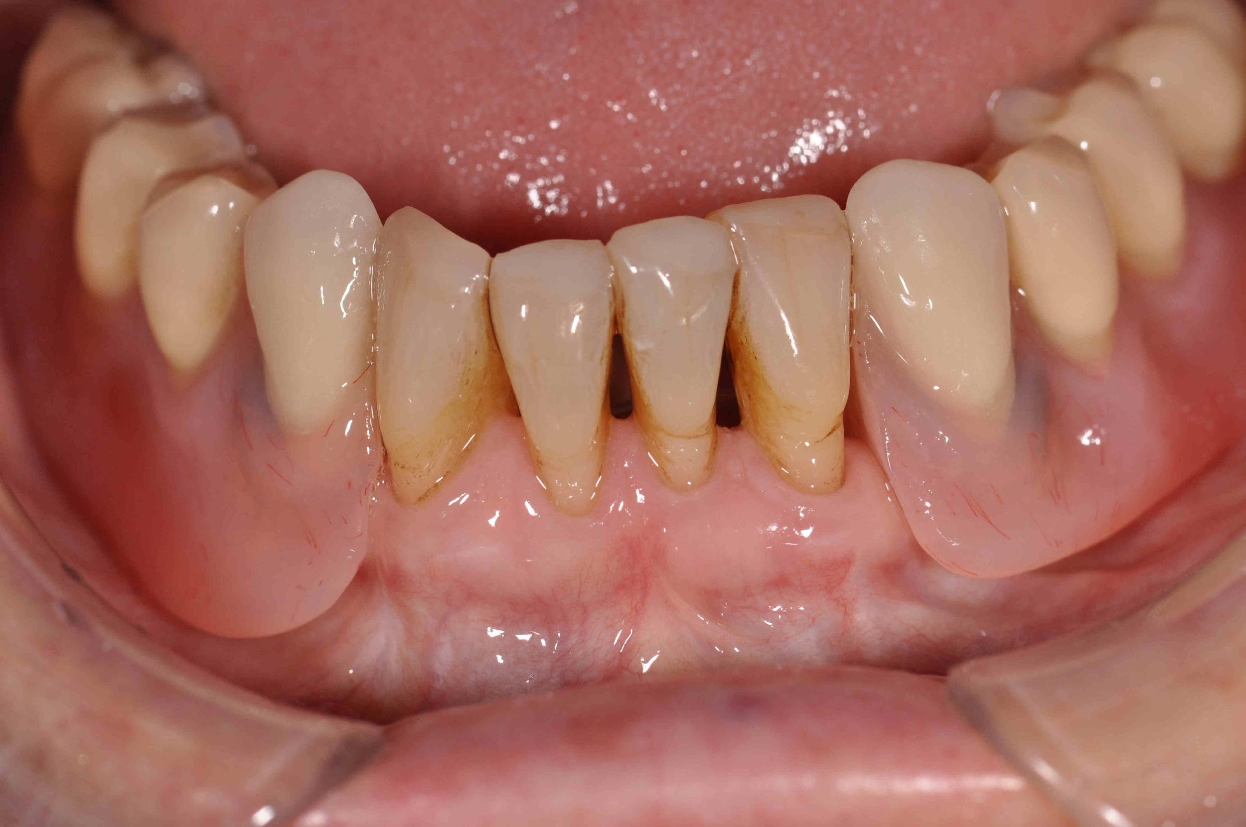 Mandibular partial overdenture in situ