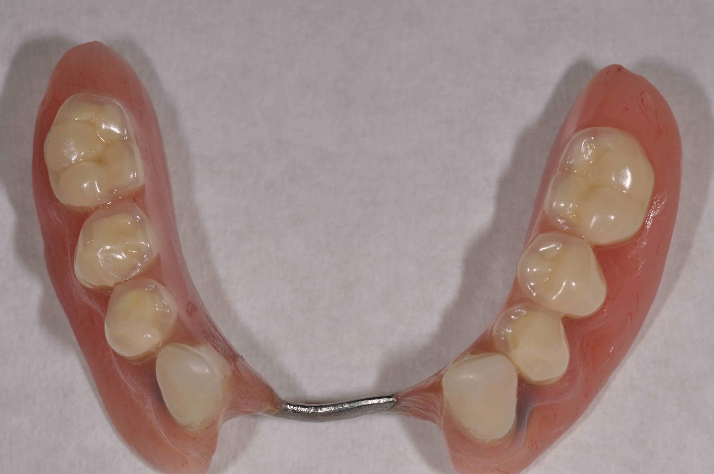 The simple design of the overdenture